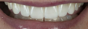 No-preparation veneers