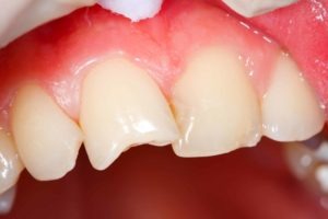My tooth is broken