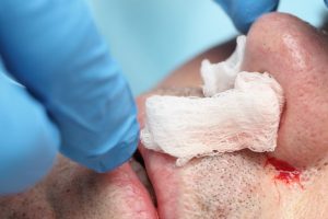 Clinical Article Epistaxis