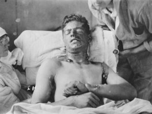 Mustard Gas Burns
