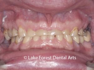 what is bruxism