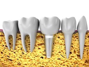 Address tooth loss