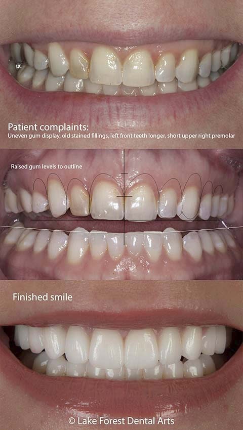 dental veneers before and after