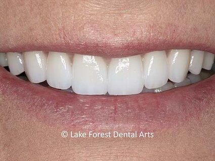 Very thin veneers