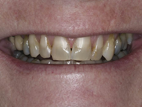 Teeth that don't bleach Teeth that don't bleach