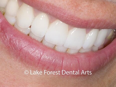 Pink gums