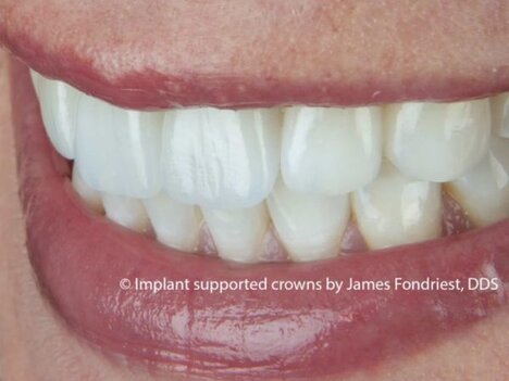 Front two teeth are dental implant crowns done by implant dentist Dental Implants | implant crown | implant dentist