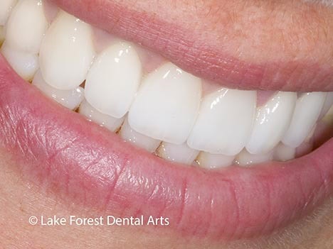 A smile created using veneers and an all porcelain bridge all porcelain bridge