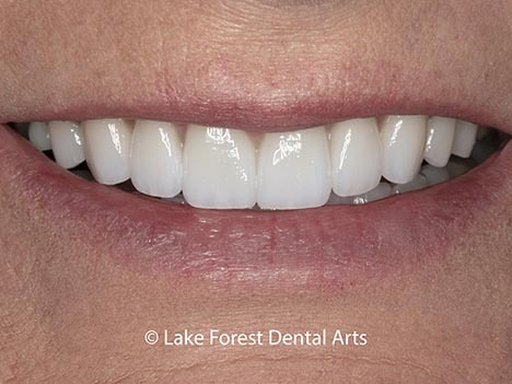 full mouth reconstruction full mouth reconstruction