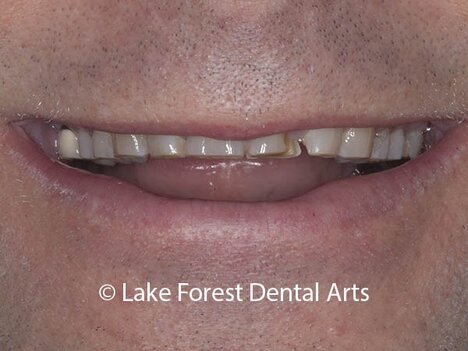 Man who grinds at night and has destroyed his teeth veneers for bruxers