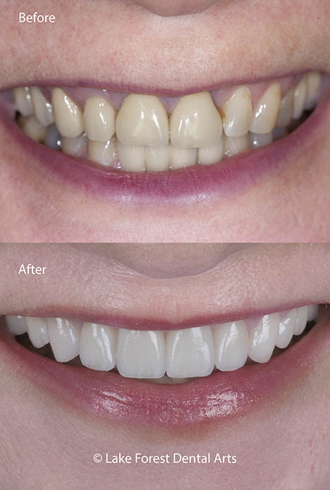 Front tooth crowns before and after