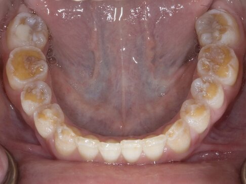 Enamel often doesn't form correctly with Celaic Dental problems with celiac disease