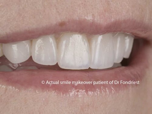 Get a smile makeover consultation done before porcelain veneers Dental consultation