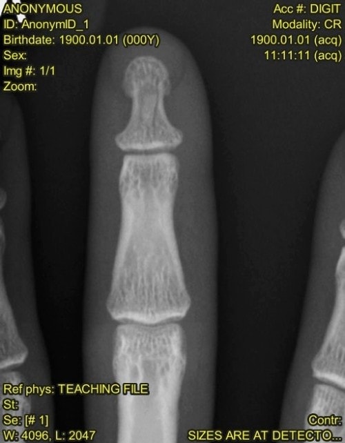 The patient is a 32-year-old man who presents with pain over the distal phalanx of the middle finger after dropping a 20-pound weight on his finger while constructing a home gym set-up. The skin is unbroken, but pain is evident upon palpation over the distal phalanx of the middle finger. Neurovascular status is intact. View the image taken (Figure 1) and consider what your diagnosis and next steps would be. Resolution of the case is described on the next page.