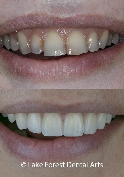 Smile makeover to straighten her teeth Dental crowns before and after
