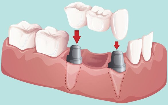 Pose bridge dentaire dentiste richard amouyal