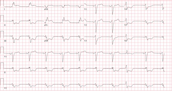 Figure 1 of ECG Image