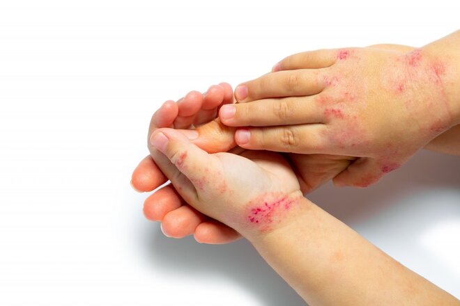 DIET AND CHILDHOOD ECZEMA