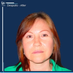 DR-BOLANOS-ANTES-_-DESPUES-34
