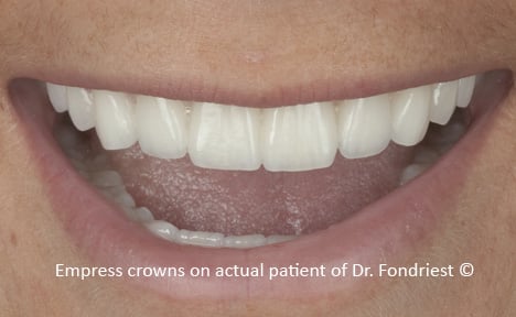 Empress crowns on front teeth of Celiac Patient Repairing celiac teeth