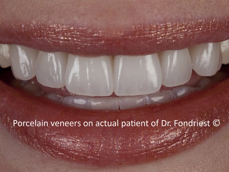 image of feldspathic porcelain veneers image of feldspathic porcelain veneers