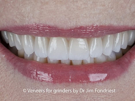 Grind proof veneers, bruxism veneers, veneers for grinders, Grind proof veneers, bruxism veneers, veneers for grinders,