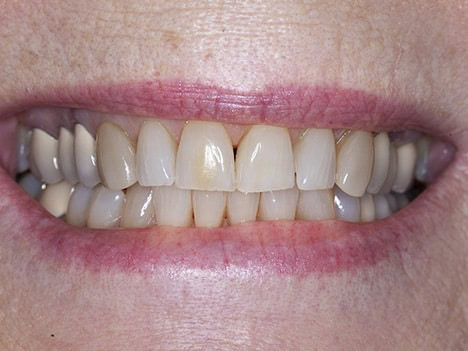Poorly matched crowns, veneers, bonding Poorly matched crowns, veneers, bonding