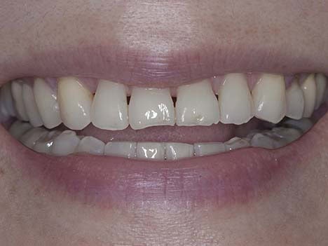 Black Triangles between teeth Black Triangles between teeth