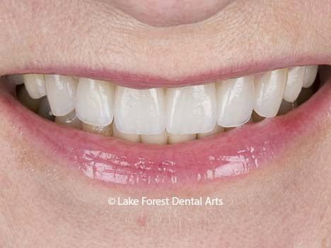 Image of E Max porcelain crowns Tooth caps before and after