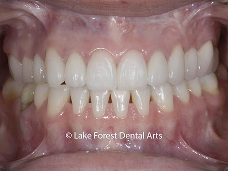 crowns with black lines Black line at gum line