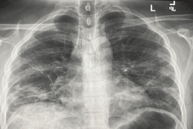 Chest X Ray Findings In 636 Ambulatory Patients With Covid 19 Presenting To An Urgent Care Center A Normal Chest X Ray Is No Guarantee Journal Of Urgent Care Medicine