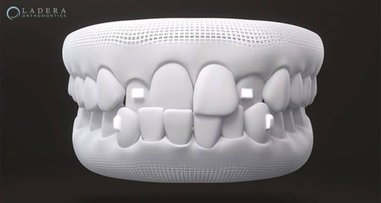 Invisalign Attachments