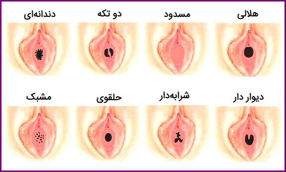 علائم پاره شدن پرده ی بکارت هایمن و انواع آن با تصویر و پارگی بکارت بدون