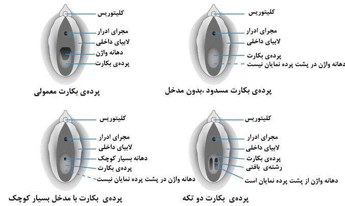 انواع پرده بکارت شکل و عکس انواع بکارت