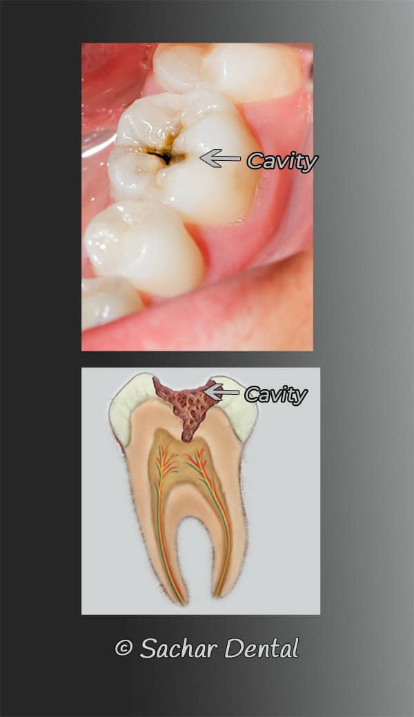 Dentist Nyc Dental Cavity Fillings Sachar Dental Nyc