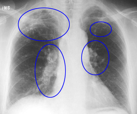 Silicosis lung disease from volcanic eruption