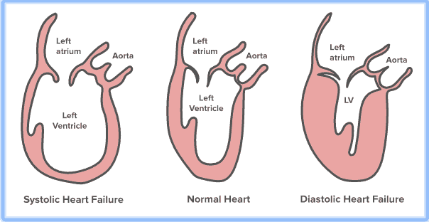 Diastolic Heart Failure