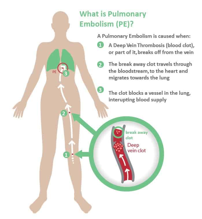 dvt veia femoral distal icd 10