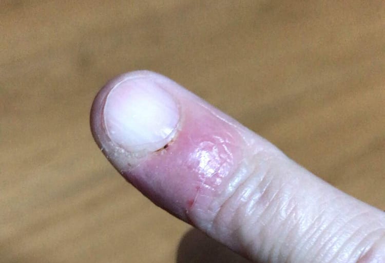 0216scary-hyouso190407_002.jpg 病院での治療後に多少良くなってきた指先の画像イメージ