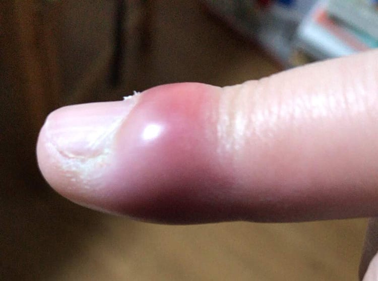 0210scary-hyouso190407_004.jpg ひょうそで指先が赤く腫れ上がりパンパンな様子の画像イメージ