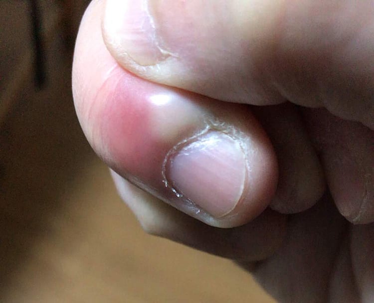 0210scary-hyouso190407_005.jpg 膿がたまっているひょうそになった右手の薬指を親指で押す画像