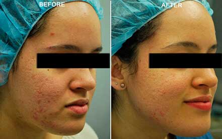 Young woman's face before and after acne treatment. Right cheek. Patient 3