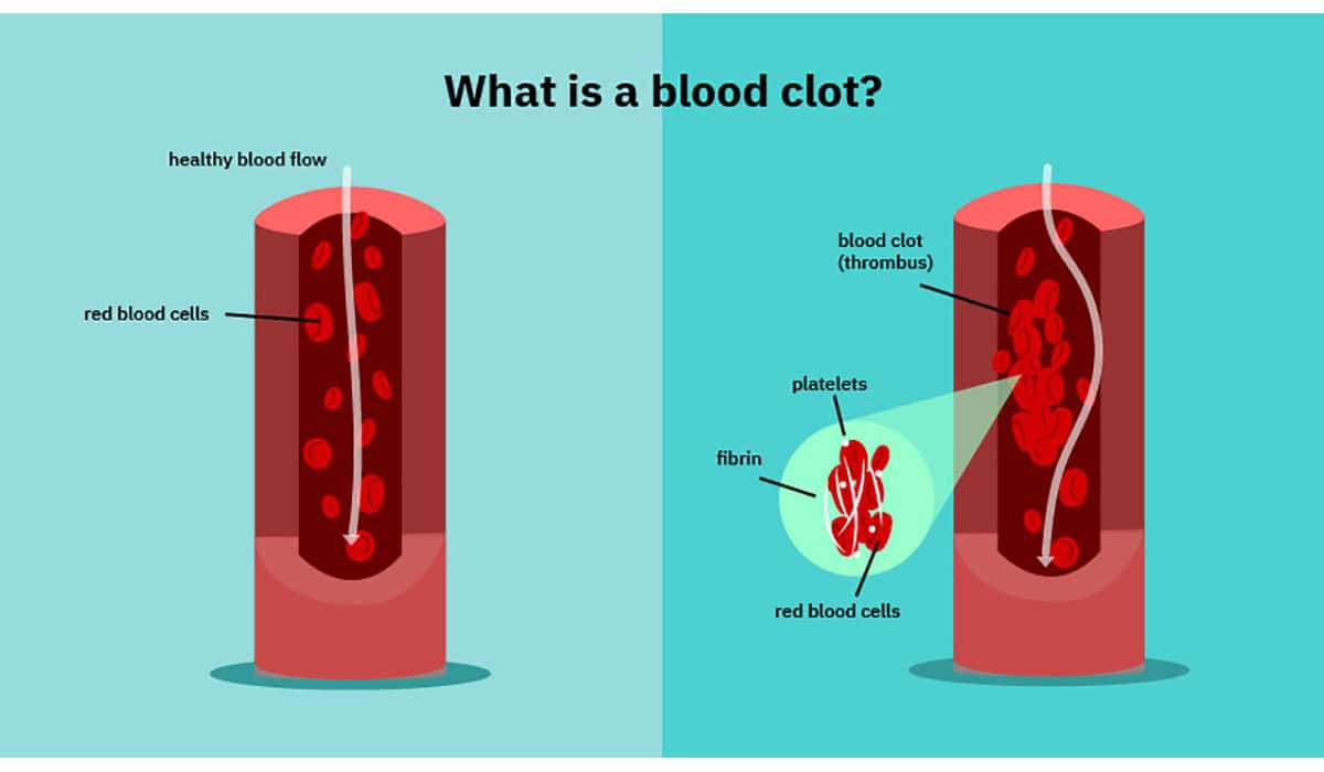 Blood Clot 01 Gatewayextension