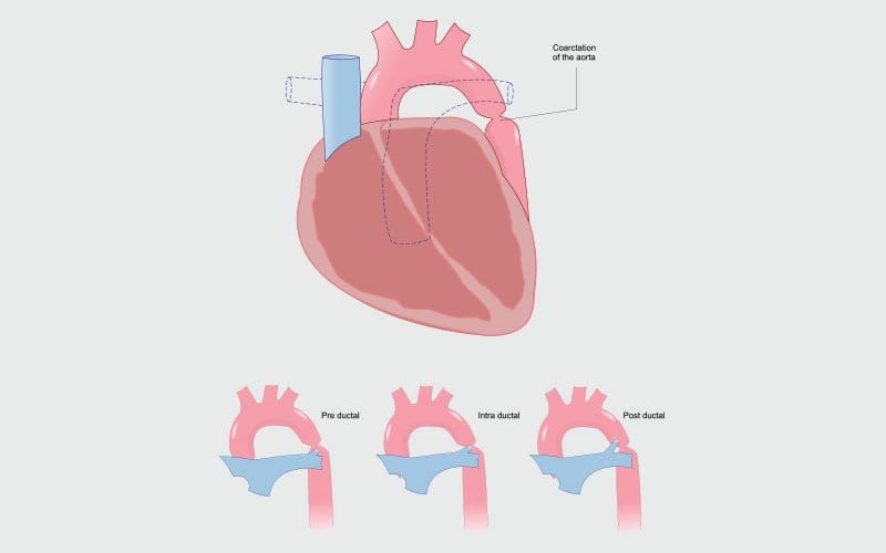 coartacao aorta