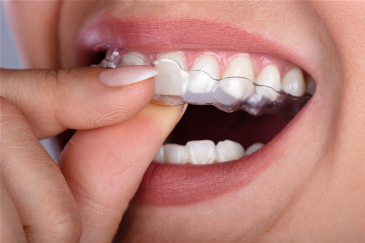 Clear Invisalign aligners