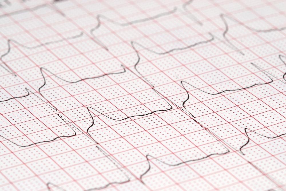12 Kanal EKG Ausdruck auf Millimeterpapier