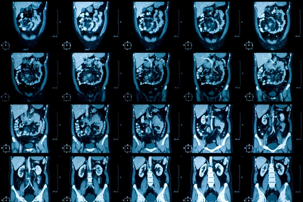 CT-Bilder vom Abdomen CT-Bilder vom Abdomen