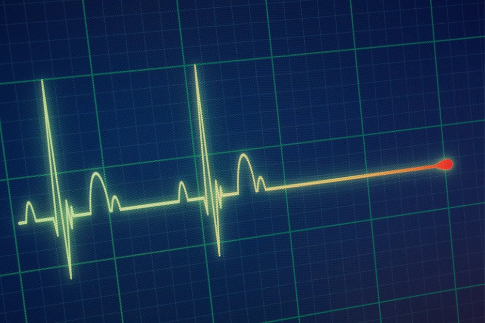 EKG-Kurven von einem Langzeit-EKG EKG-Kurven von einem Langzeit-EKG