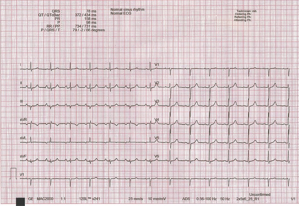 Ein normales 12 Kanal EKG.