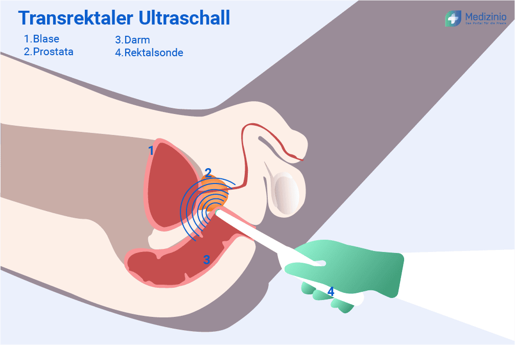Transrektaler Ultraschall (TRUS) Transrektaler Ultraschall (TRUS)